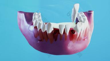 陶瓷牙科植入过程